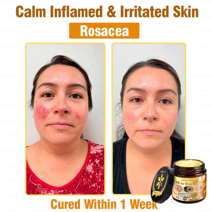 Official Store ✅ADNOON®🌸 Multi-Effect All-in-One Skincare Cream 👨‍⚕️ Recommended by the Canadian Dermatology Association (CDA) for treating skin cancer, eczema, acne, warts, psoriasis, wrinkles, scars, and varicose veins.