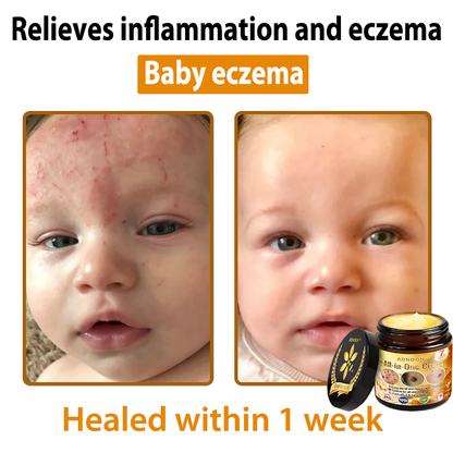 Official Store ✅ADNOON®🌸 Multi-Effect All-in-One Skincare Cream 👨‍⚕️ Recommended by the Canadian Dermatology Association (CDA) for treating skin cancer, eczema, acne, warts, psoriasis, wrinkles, scars, and varicose veins.