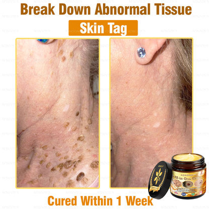 Official Store ✅ADNOON®🌸 Multi-Effect All-in-One Skincare Cream 👨‍⚕️ Recommended by the Canadian Dermatology Association (CDA) for treating skin cancer, eczema, acne, warts, psoriasis, wrinkles, scars, and varicose veins.